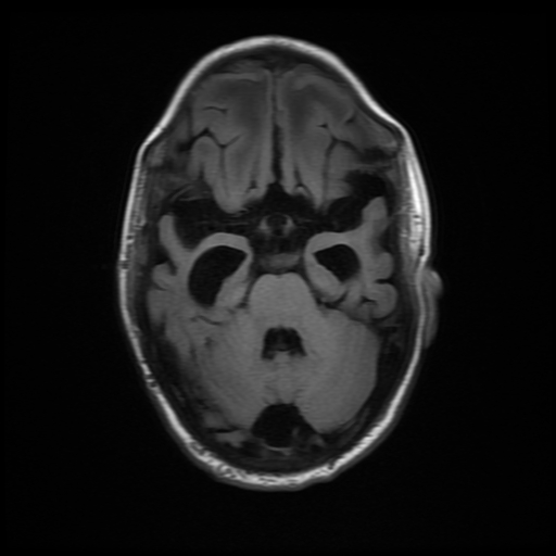 File:Cerebral manifestations of mucopolysaccharidosis type I (Radiopaedia 59171-66487 C 6).jpg