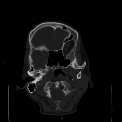 Cerebral metastases - breast primary (Radiopaedia 77653-89857 Axial bone window 19).jpg