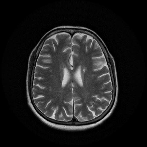 File:Cerebral metastases - melanoma (Radiopaedia 80972-94522 Axial T2 20).jpg