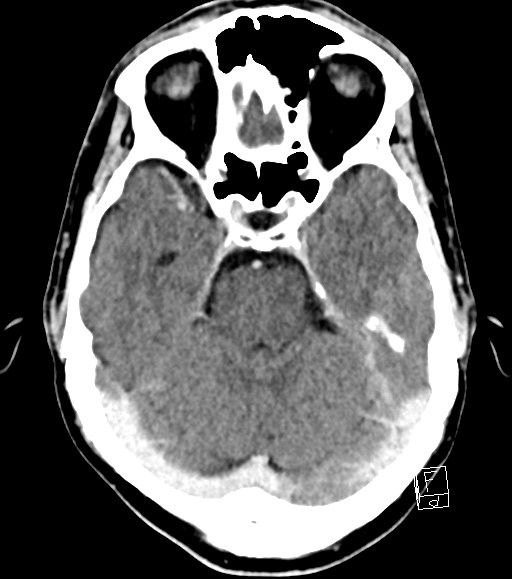 Cerebral metastases - testicular choriocarcinoma (Radiopaedia 84486-99855 Axial C+ delayed 38).jpg
