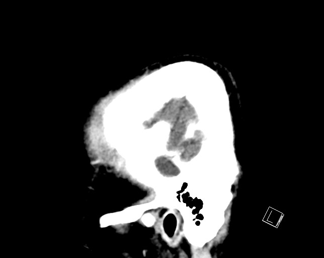 Cerebral metastases - testicular choriocarcinoma (Radiopaedia 84486-99855 F 51).jpg