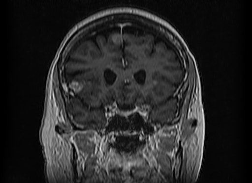 Cerebral metastases from lung cancer with amyloid angiopathy and cerebellopontine angle meningioma (Radiopaedia 74306-85191 Coronal T1 C+ 19).jpg
