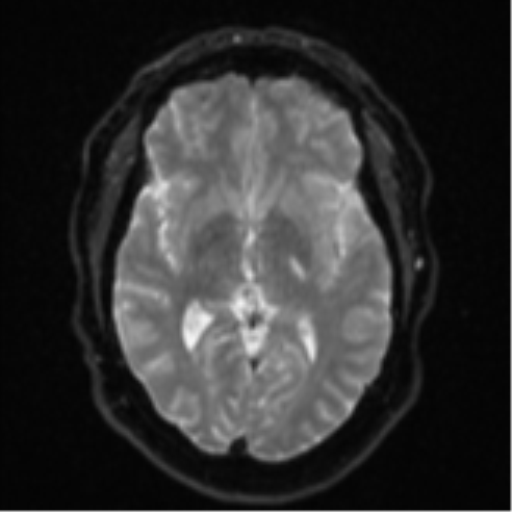 Cerebral metastases mimicking multifocal glioblastoma (Radiopaedia 50843-56353 Axial DWI 13).png