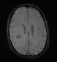 Cerebral metastasis - melanoma (Radiopaedia 54718-60954 Axial SWI 37).png