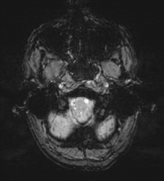 Cerebral metastasis - melanoma (Radiopaedia 54718-60954 Axial SWI 5).png