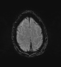 Cerebral metastasis - melanoma (Radiopaedia 54718-60954 Axial SWI 50).png