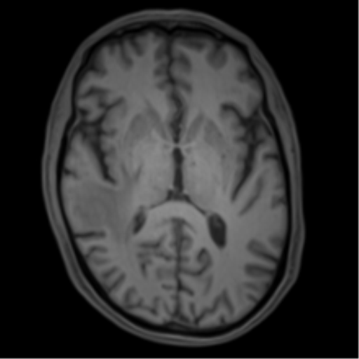 File:Cerebral metastasis - melanoma (Radiopaedia 54718-60954 Axial T1 27).png