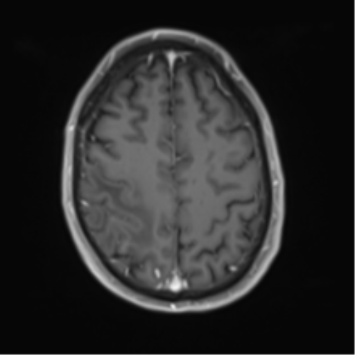 File:Cerebral metastasis - melanoma (Radiopaedia 54718-60954 Axial T1 C+ fat sat 41).png