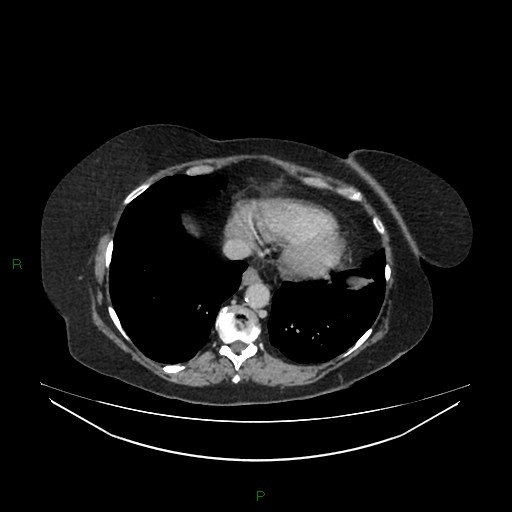 Cerebral metastasis from renal cell carcinoma (Radiopaedia 82306-96378 A 15).jpg