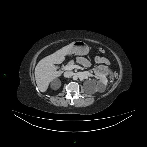 Cerebral metastasis from renal cell carcinoma (Radiopaedia 82306-96378 A 64).jpg