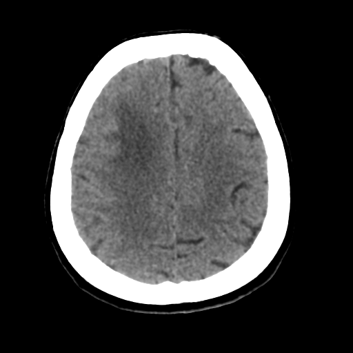 Cerebral metastasis to basal ganglia (Radiopaedia 81568-95412 Axial non-contrast 46).png