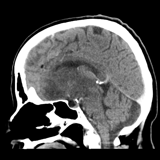 File:Cerebral metastasis to basal ganglia (Radiopaedia 81568-95412 Sagittal C+ delayed 30).png