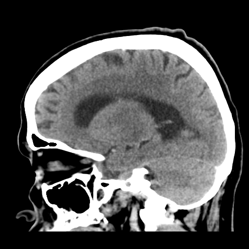 Cerebral metastasis to basal ganglia (Radiopaedia 81568-95412 Sagittal C+ delayed 37).png