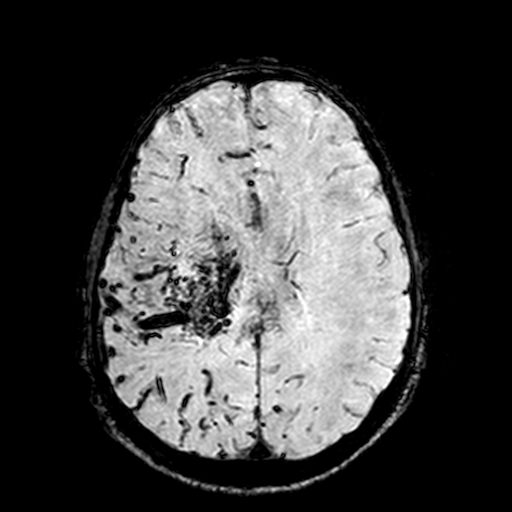 Cerebral parenchymal arteriovenous malformation (Radiopaedia 27280-27456 Axial SWI 76).jpg
