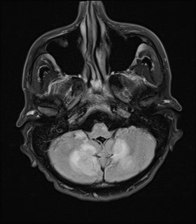 File:Cerebral toxoplasmosis (Radiopaedia 43956-47461 Axial FLAIR 4).jpg