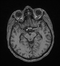 Cerebral toxoplasmosis (Radiopaedia 43956-47461 Axial T1 31).jpg