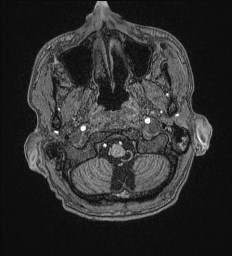 File:Cerebral toxoplasmosis (Radiopaedia 43956-47461 Axial T1 4).jpg