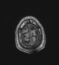 Cerebral toxoplasmosis (Radiopaedia 43956-47461 Axial T1 74).jpg