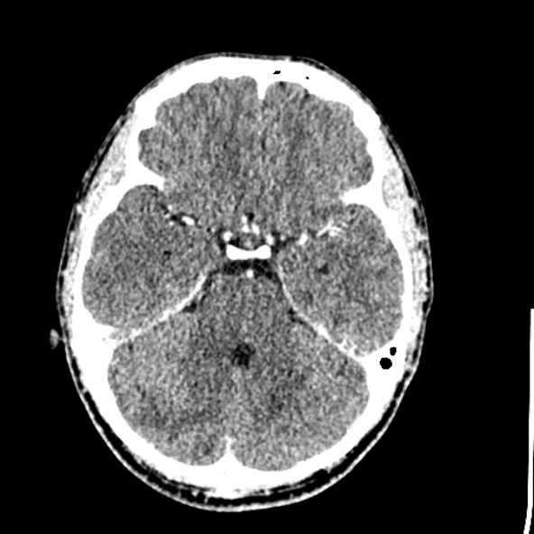 File:Cerebral toxoplasmosis (Radiopaedia 53993-60131 Axial C+ delayed 24).jpg