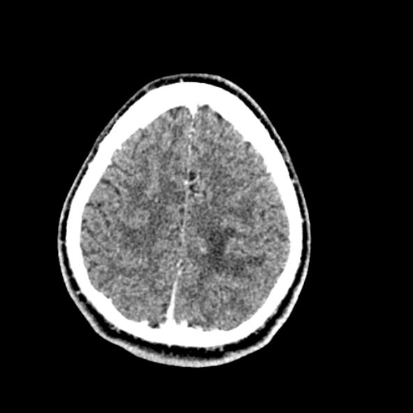 File:Cerebral toxoplasmosis (Radiopaedia 53993-60131 Axial C+ delayed 59).jpg