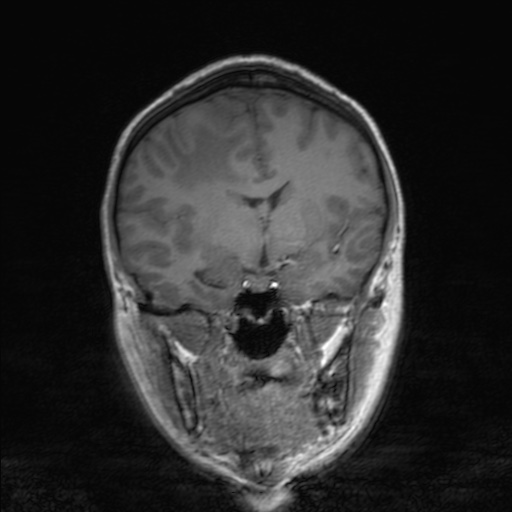 Cerebral tuberculosis with dural sinus invasion (Radiopaedia 60353-68090 Coronal T1 85).jpg