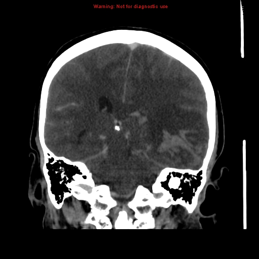 Cerebral venous infarction (Radiopaedia 12404-20735 B 50).jpg