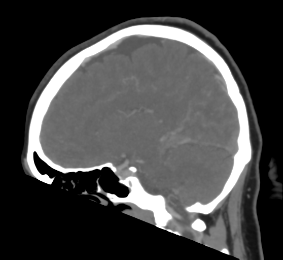 Cerebral venous infarction due to transverse sinus thrombosis (Radiopaedia 34688-36120 Sagittal CT venogram 25).png