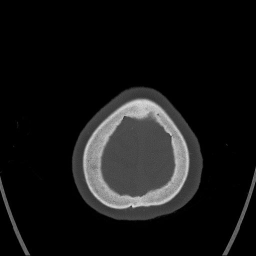 Cerebral venous infarction with hemorrhage (Radiopaedia 65343-74381 Axial bone window 181).jpg