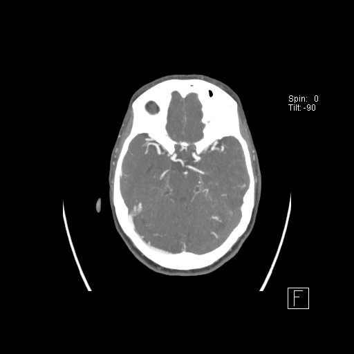 Cerebral venous infarction with hemorrhage (Radiopaedia 65343-74396 A 41).jpg