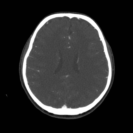 Cerebral venous sinus thrombosis (Radiopaedia 40619-43227 A 144).jpg
