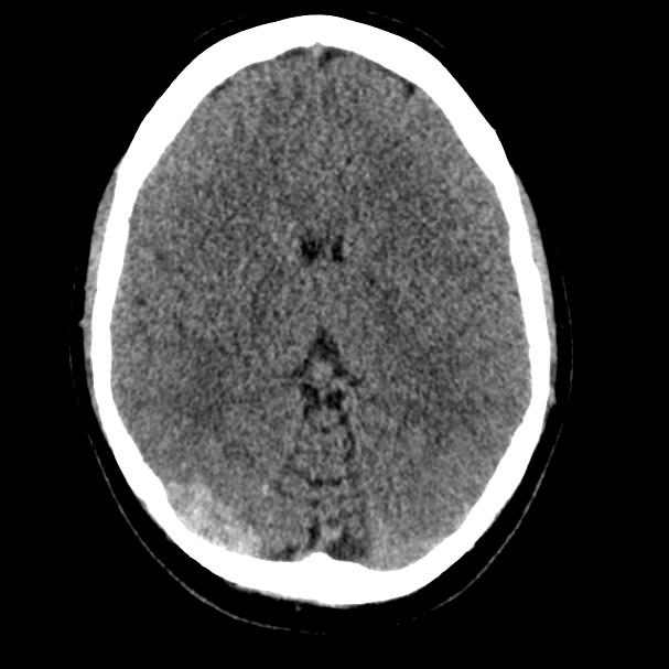 Cerebral venous sinus thrombosis (Radiopaedia 59224-66551 Axial non-contrast 15).jpg