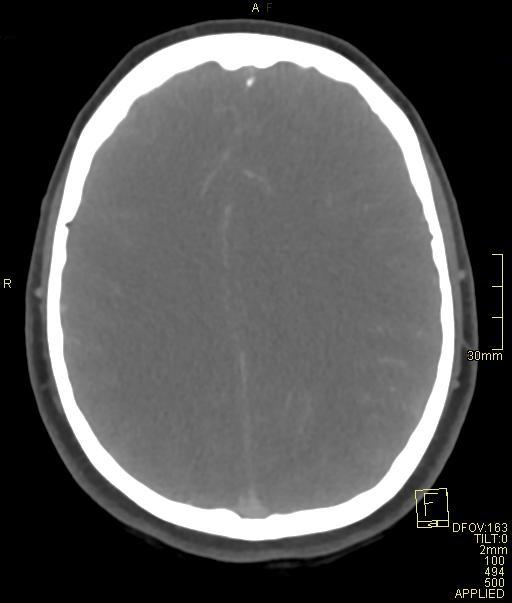 Cerebral venous sinus thrombosis (Radiopaedia 91329-108965 Axial venogram 54).jpg