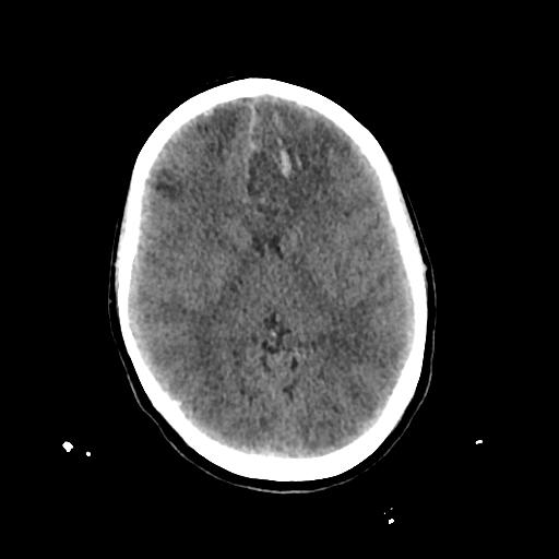 File:Cerebral venous throbmosis - hemorrhagic venous infarction (Radiopaedia 87318-103613 Axial non-contrast 82).jpg