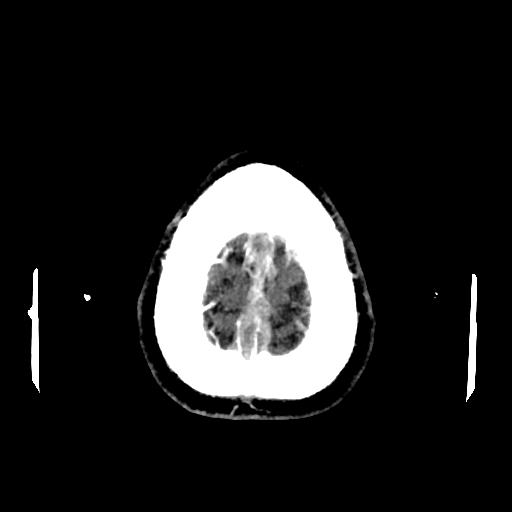 File:Cerebral venous thrombosis (CVT) (Radiopaedia 77524-89685 Axial with contrast 35).jpg