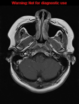 File:Cerebral venous thrombosis (Radiopaedia 37224-39208 Axial T1 C+ 4).jpg
