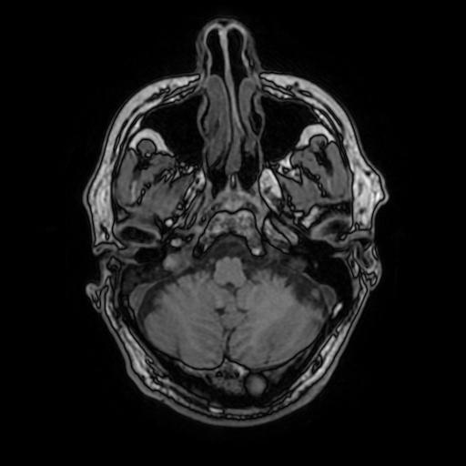 File:Cerebral venous thrombosis with secondary intracranial hypertension (Radiopaedia 89842-106957 Axial T1 47).jpg