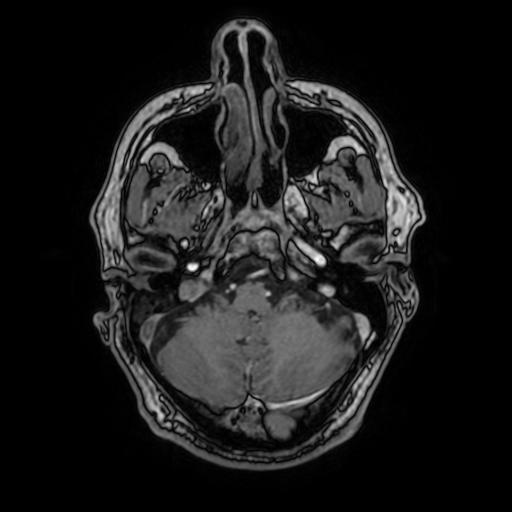File:Cerebral venous thrombosis with secondary intracranial hypertension (Radiopaedia 89842-106957 Axial T1 C+ 49).jpg
