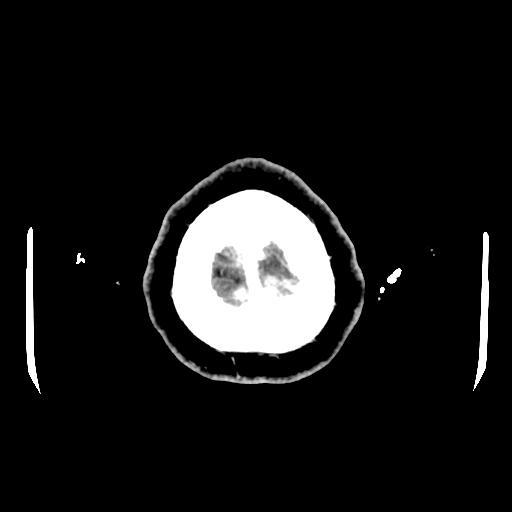 Cerebral venous thrombosis with venous hemorrhagic infarct (Radiopaedia 90354-107660 Axial with contrast 164).jpg