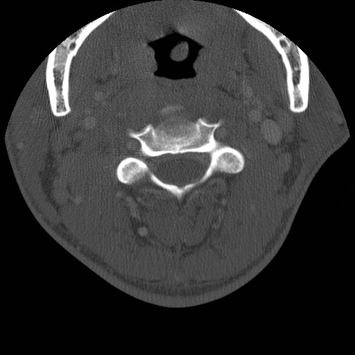 Cervical Pott disease (Radiopaedia 20374-20286 Axial bone window 49).jpg