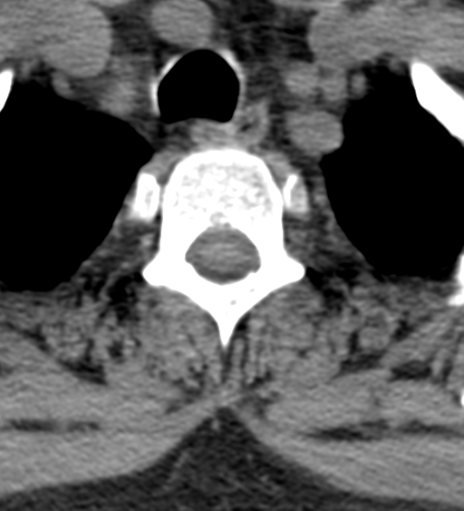 File:Cervical canal stenosis - OPLL and osteophytes (Radiopaedia 47329-51910 Axial non-contrast 60).png