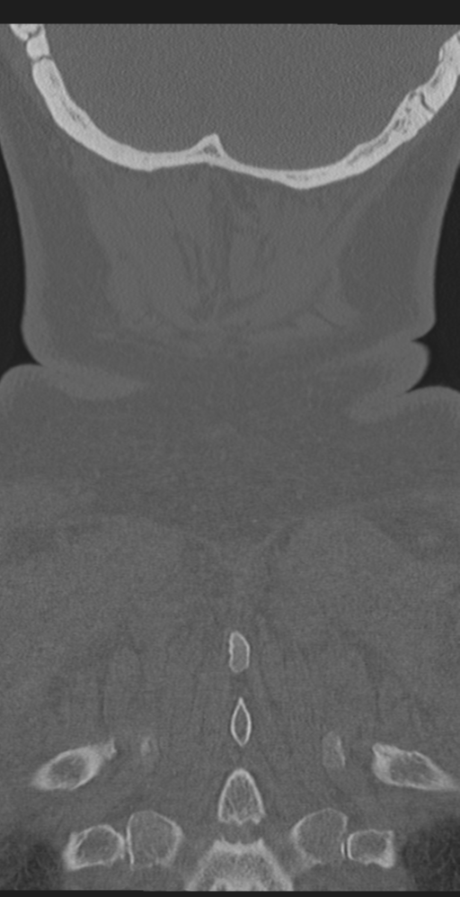 Cervical canal stenosis due to ossification of the posterior longitudinal ligament (Radiopaedia 47260-51823 Coronal bone window 64).png