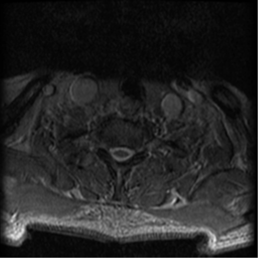 Cervical canal stenosis with cord compression (Radiopaedia 34114-35374 Axial Gradient Echo 12).png