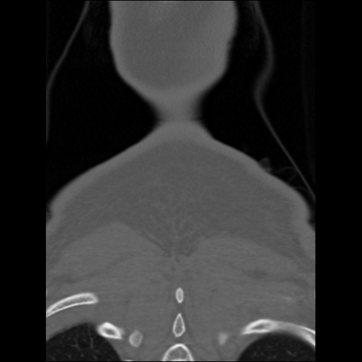 File:Cervical rib (Radiopaedia 71110-81363 Coronal non-contrast 5).jpg
