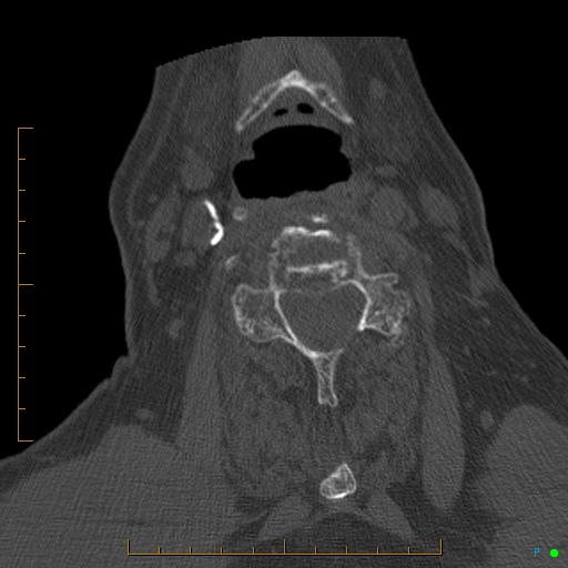 Cervical spine fracture - ankylosing spondylitis (Radiopaedia 76835-88706 Axial bone window 123).jpg