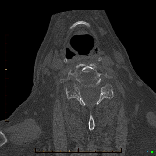 Cervical spine fracture - ankylosing spondylitis (Radiopaedia 76835-88706 Axial bone window 137).jpg