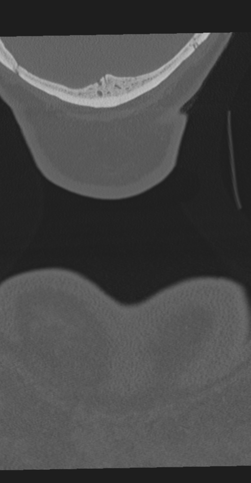 Cervical spine fracture in the setting of ankylosis (Radiopaedia 37038-38715 Coronal bone window 86).png