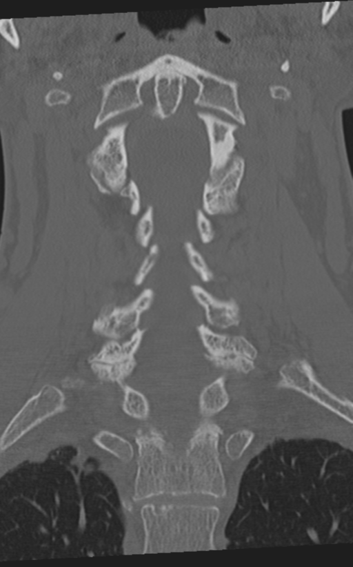 Cervical spine fractures with vertebral artery dissection (Radiopaedia 53296-59268 Coronal bone window 36).png