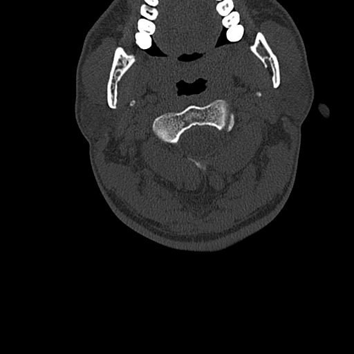 File:Cervical spine trauma with tear drop fracture and perched facet joint (Radiopaedia 53989-60127 Axial bone window 31).jpg