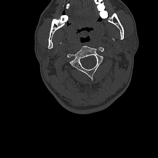 File:Cervical spine trauma with tear drop fracture and perched facet joint (Radiopaedia 53989-60127 Axial bone window 40).jpg