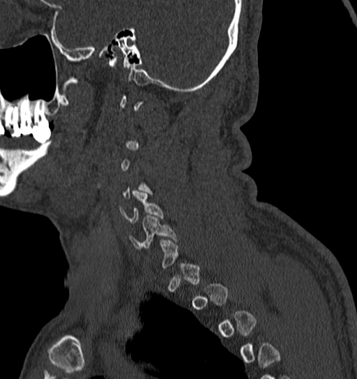 Cervical spine trauma with tear drop fracture and perched facet joint (Radiopaedia 53989-60127 Sagittal bone window 16).jpg